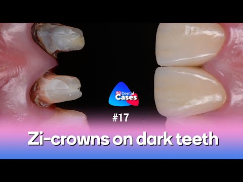 Zi-crowns on dark teeth  | BG Dental Cases #17