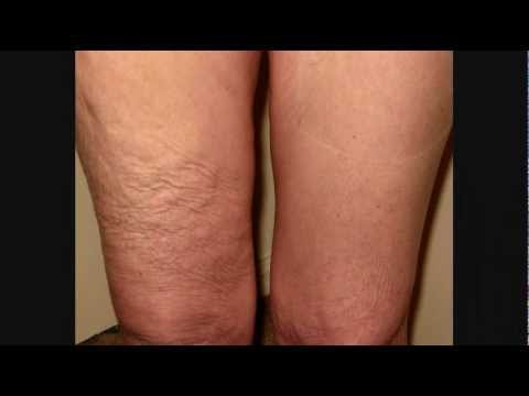 Creams To Tighten Loose Skin After Weight Loss