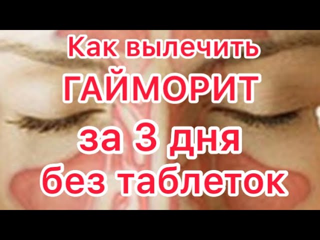 Как вылечить гайморит в домашних условиях/ ПРОВЕРЕНО НА СЕБЕ