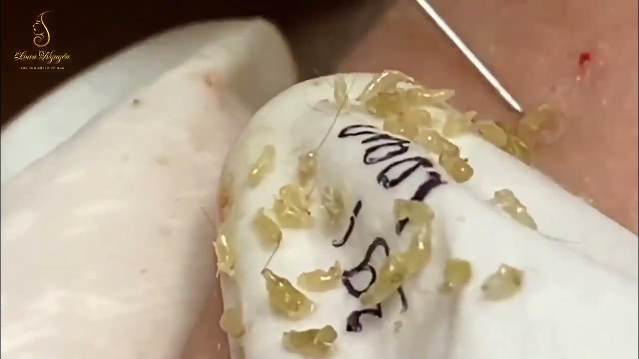 massive blackheads on nose and lips Clean Giant Blackheads on Nose