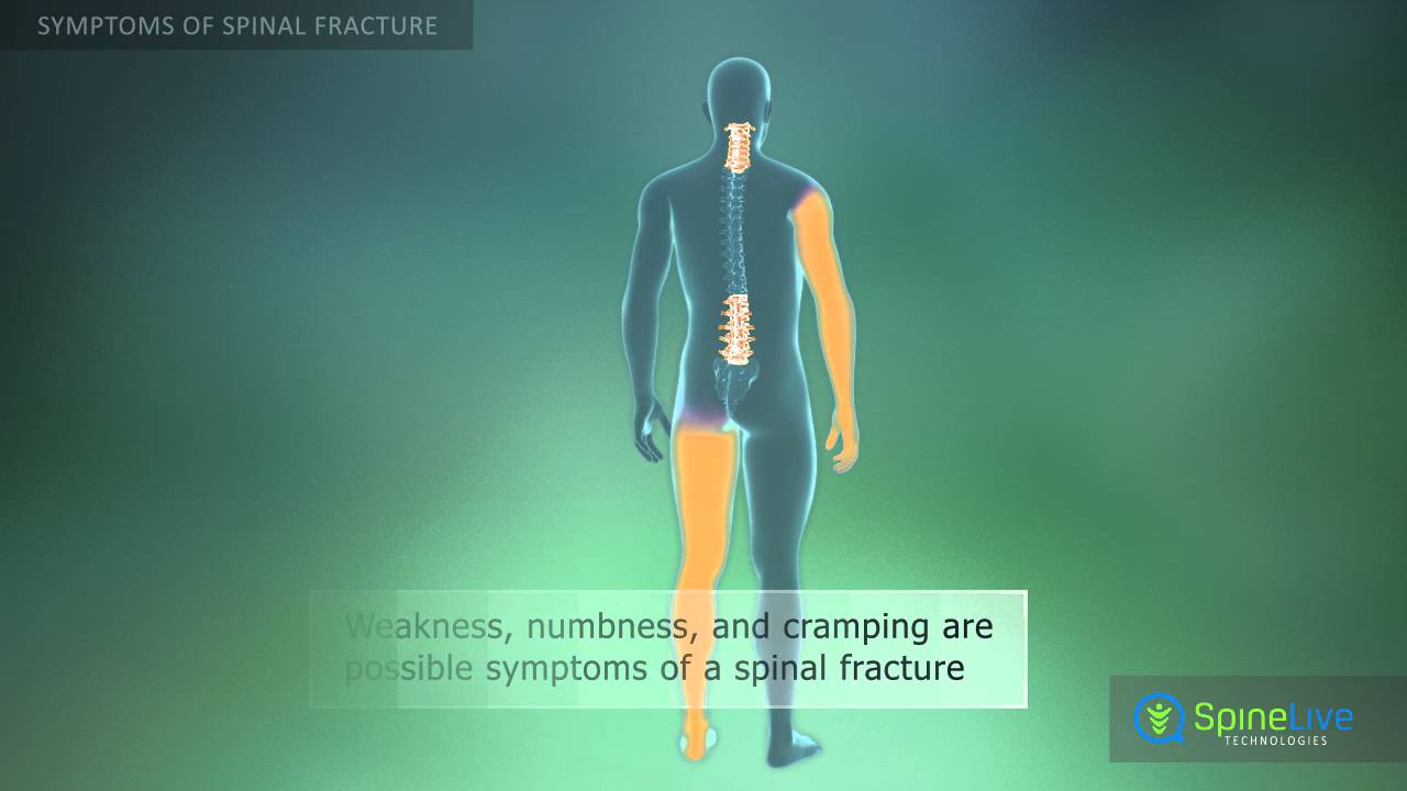 Spinal fracture. Symptoms - YouTube