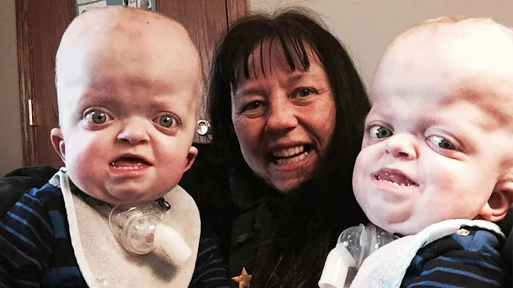 Grandma Adopts Twins With Rare Genetic Disease, Says She's 'Privileged'