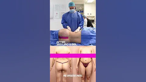 Transformation: Stunning Results of 360 Liposuction And Brazilian Butt Lift (bbl)