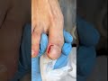 Pedicure | Pus | Wound | Podologia #asmrvideo #pedicure #podologia