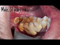 Half jaw quarter hour scaling  dentist  dokter gigi tri putra