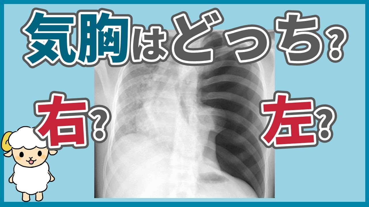 胸部 レントゲン 気胸