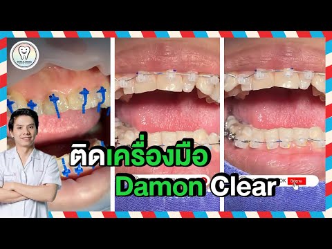 จัดฟันแบบดามอน Damon Clear #จัดฟัน #Shorts