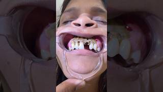 Poor Unfortunate Patient After BOTCHED up Necrotic Upper Jaw Surgery - Beware!!