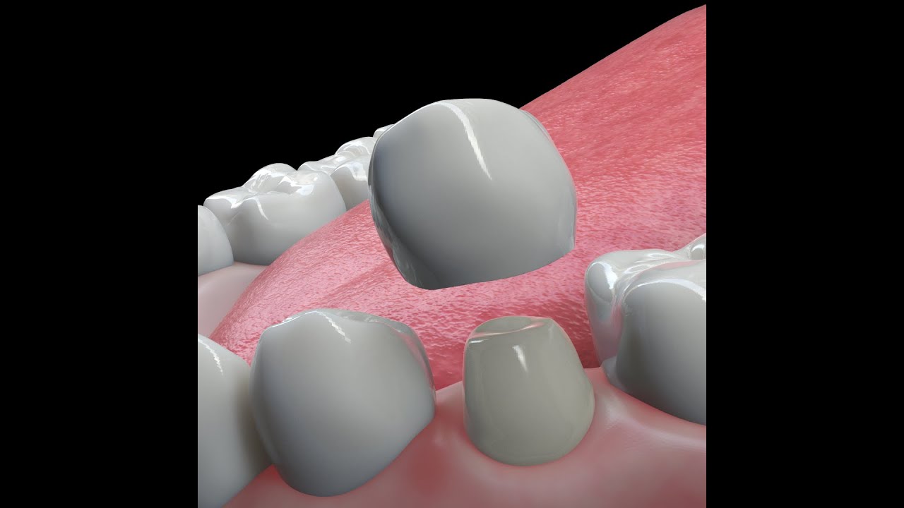 Dental Crowns YouTube