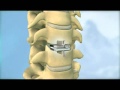 Disc replacement surgery for the neck