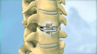 Disc replacement surgery for the neck