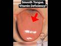 Atrophic Glossitis Explained #mbbs