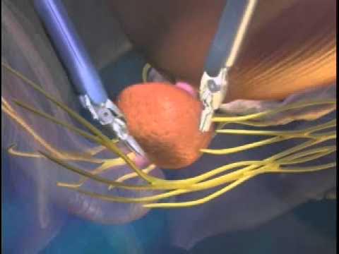 Видео простата сүті Видео простата сүті