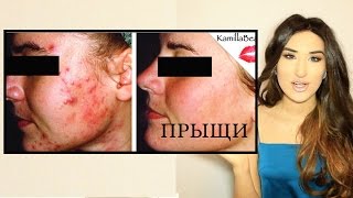 Как БЫСТРО  ОЧИСТИТЬ ЛИЦО от ПРЫЩЕЙ АКНЕ 100% Kamillabeauty