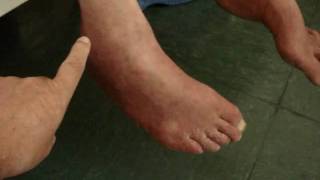 De tobillo tratamiento neuropatía de