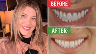 Must Watch! How My Phonares Hybrid Dentures were Designed