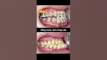 Cận cảnh quá trình thay đổi khớp cắn ngược mức độ 2