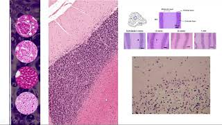 Capitulo 8 Tejido nervioso Ataxia cerebelosa