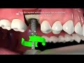 Straumann tlx implant system step by step