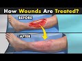 Wound Debridement Procedure | Unbelievable Ways Doctors Treat Wounds!