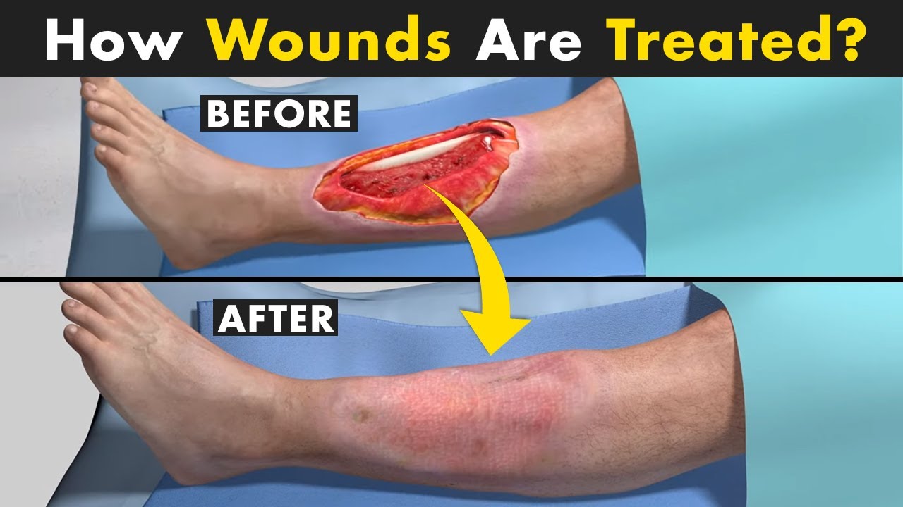 Wound Debridement Procedure | Unbelievable Ways Doctors Treat Wounds!