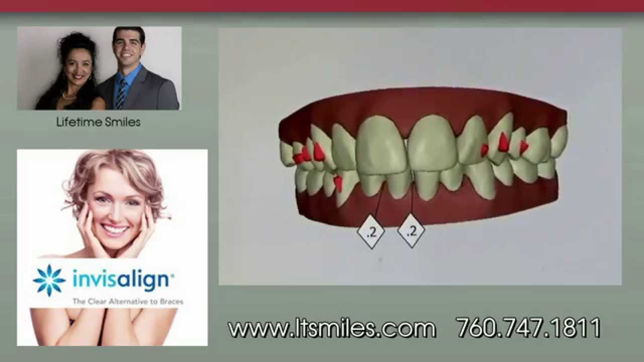 Braces | Invisalign | Escondido