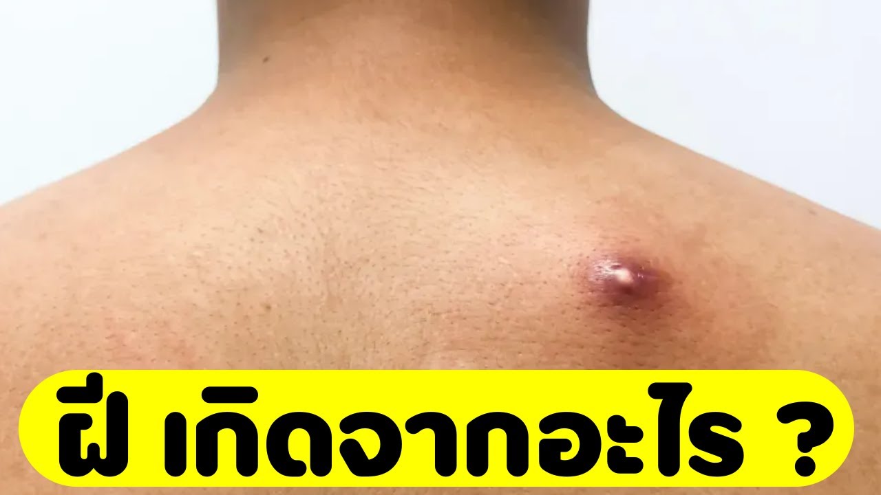 ฝี เกิดจากอะไร วิธีแก้ วิธีรักษา ทำอย่างไร? - YouTube