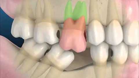 ¿Cuáles son los efectos secundarios de extraer un diente?