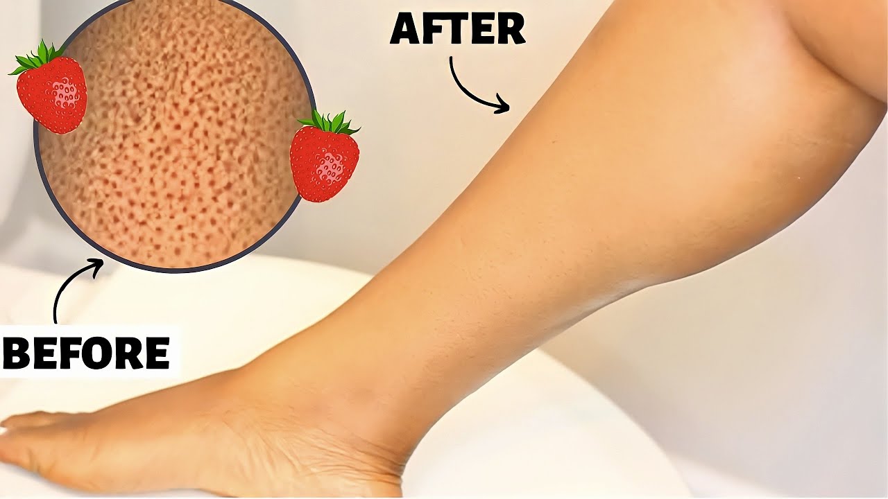 How To Get Rid Of STRAWBERRY LEGS 🍓 in ONE DAY WITH PROOF! 🔥 YouTube — free download