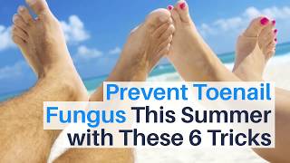 Prevent Toenail Fungus This Summer with These 6 Tricks