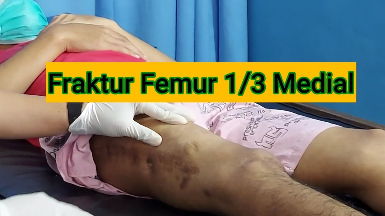 Latihan pasca operasi patah tulang paha ||post op fraktur femur