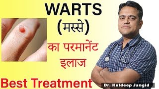 WARTS Best Treatment | मस्से का परमानेंट इलाज | Warts Homeopathic Treatment