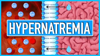 Hypernatremia | Pathophysiology, Etiologies, Consequences, and Treatment