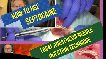 How to use Septocaine and Needle Injection Technique With Minimal Pain and Discomfort For Your Pt