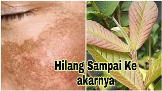 THE SECRET TO REMOVING BLACK SPOTS AND ACNE BY USING GUAVA LEAVES, PROVEN EFFECTIVE??!