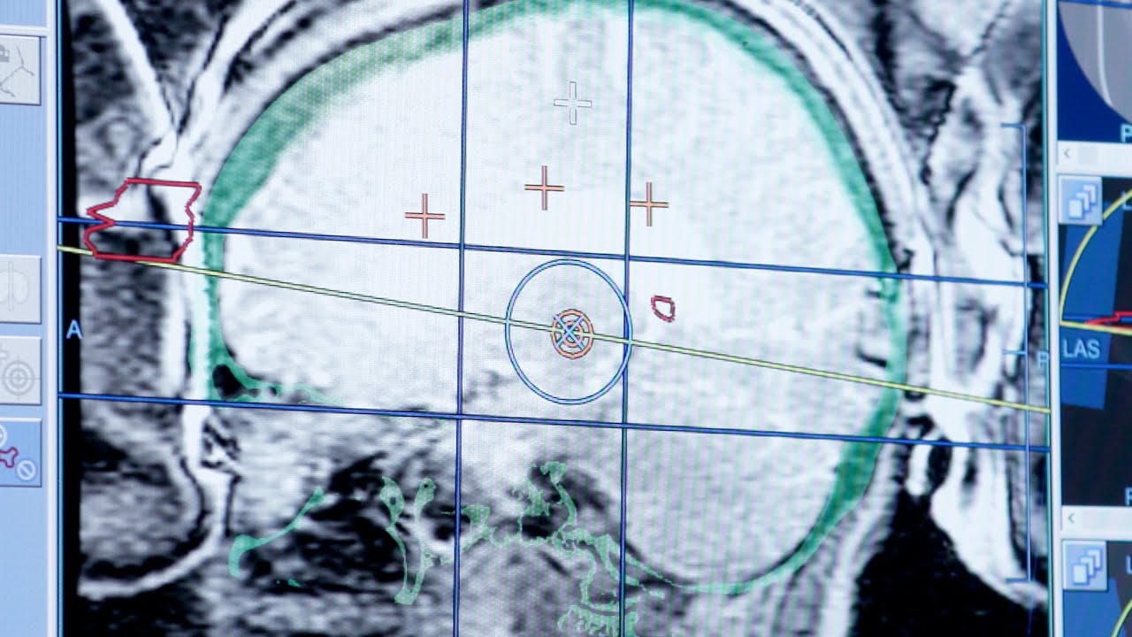 A Steady Hand: Treating Essential Tremor with Focused Ultrasound - YouTube