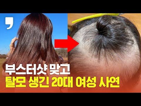 부스터샷(<strong>백신</strong> 3차 접종) 맞고 탈모 생긴 20대 여성 ㅣ Covid-<strong>19</strong> Vaccine Side Effect