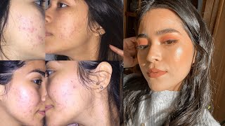 HOW I CLEARED MY SKIN and kept it that way! 5 TIPS non related to food or exercise!