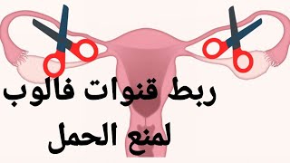 عملية ربط الرحم لعدم الانجاب (عملية الربط) ربط قنوات فالوب tubal ligation or tubal sterilization