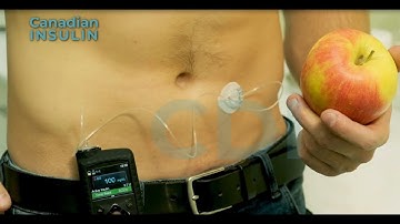 Artificial pancreas for Type 2 Diabetes