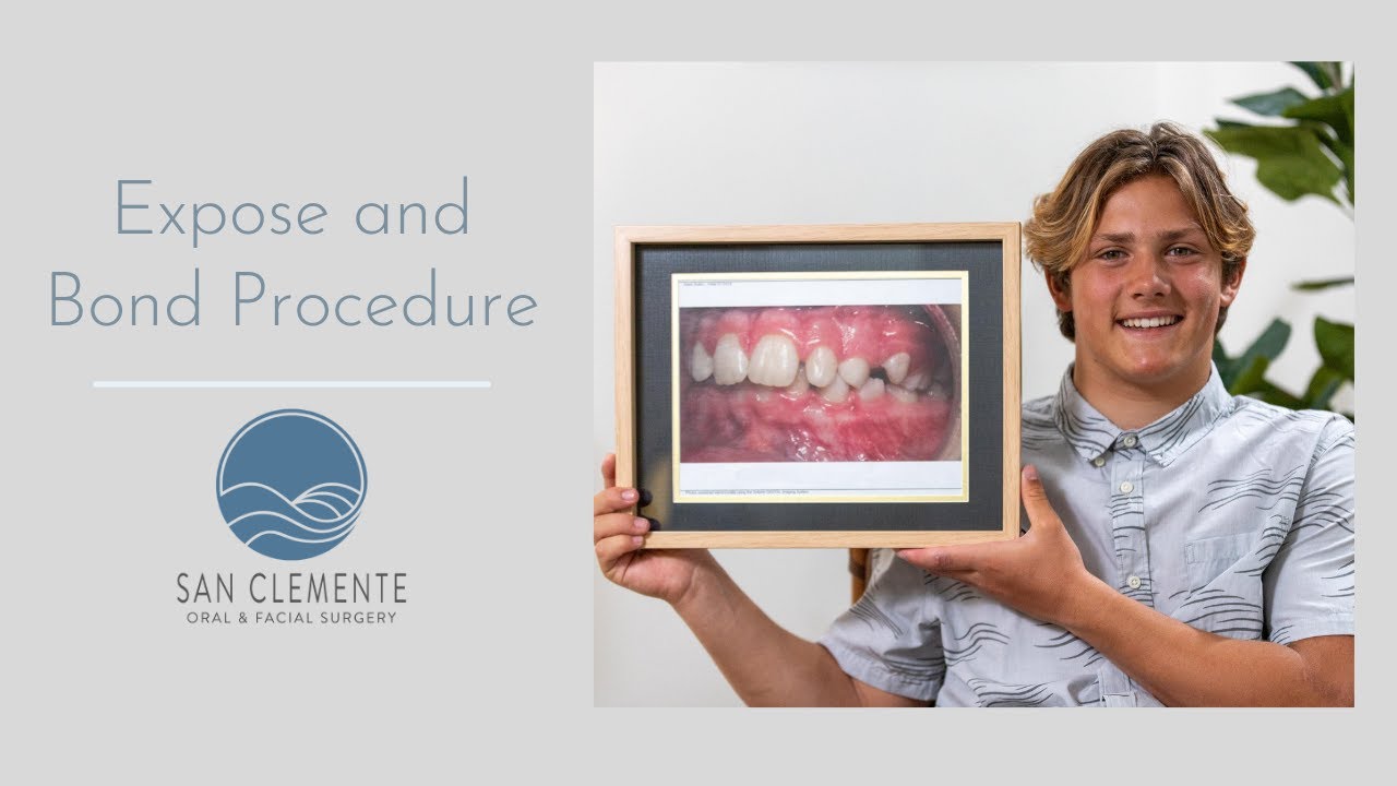 How an Expose and Bond Procedure Helped An Orthodontic Procedure YouTube