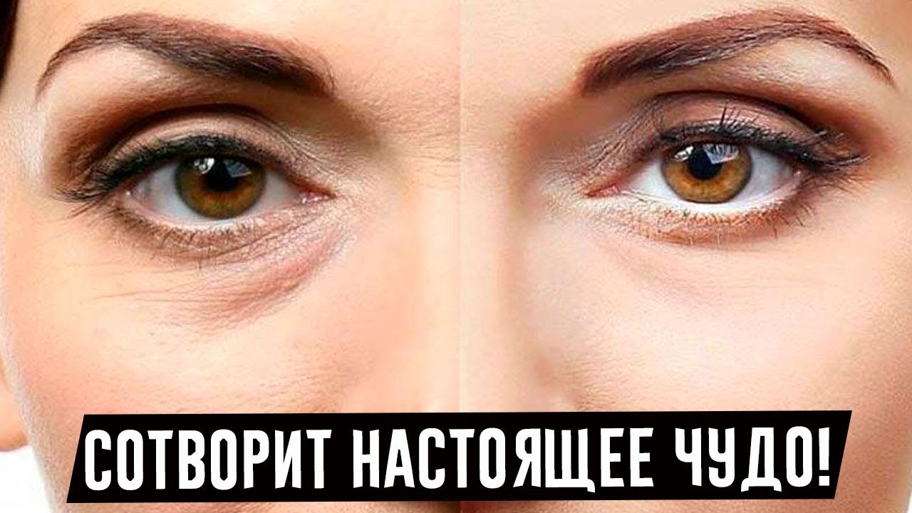 Солкосерил — одно из лучших средств от морщин вокруг глаз. КОСМЕТОЛОГИ НЕГОДУЮТ!