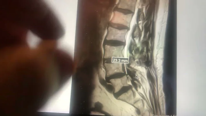 SPONDYLOLISTHESI...  & STENOSIS