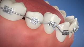 Adult Braces Procedure