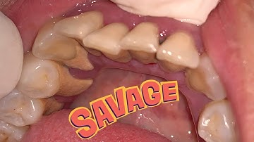 Save your smile | Scaling | Dokter Gigi Tri Putra