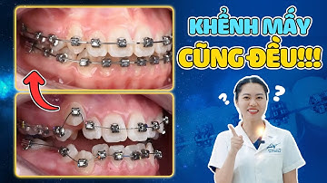 3 Case Răng Khấp Khểnh “Không Ai Dám Nhận” – Và Cái Kết Bất Ngờ! - Nha Khoa Lạc Việt Intech