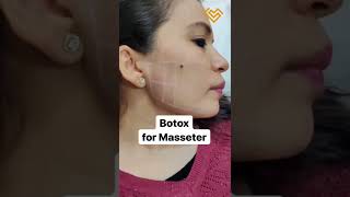 Botox for Masseter helps with: TMJ, Grinding, Jawline Slimming, Clenching.