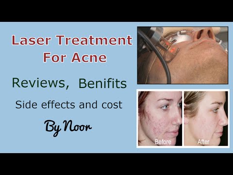 Laser treatment for acne - Reviews, benifits ,Side effects and cost by Noor