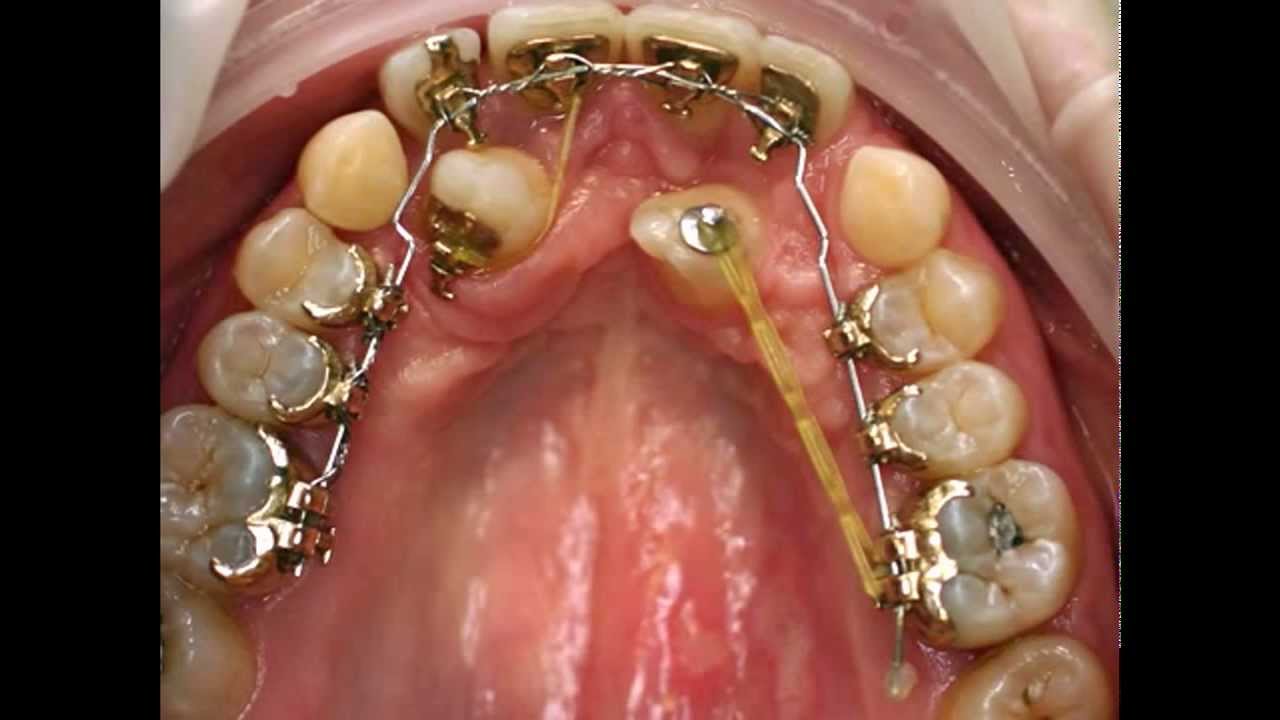 Incognito - Speciale Terapia di Ortodonzia Linguale