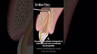Apicectomía dental/ Dental Apicectomy